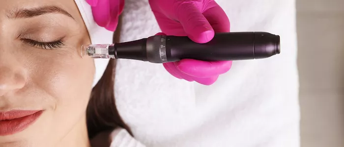 Il microneedling ai "Lunedì del benessere"